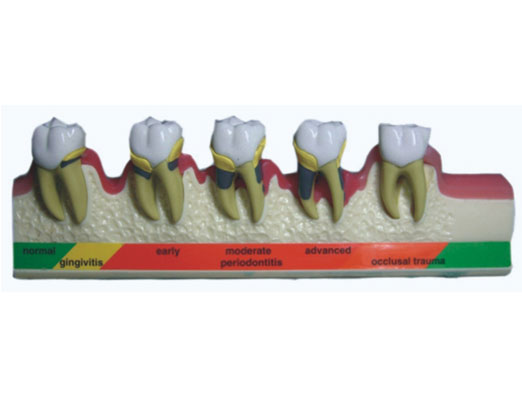 牙周病分类模型